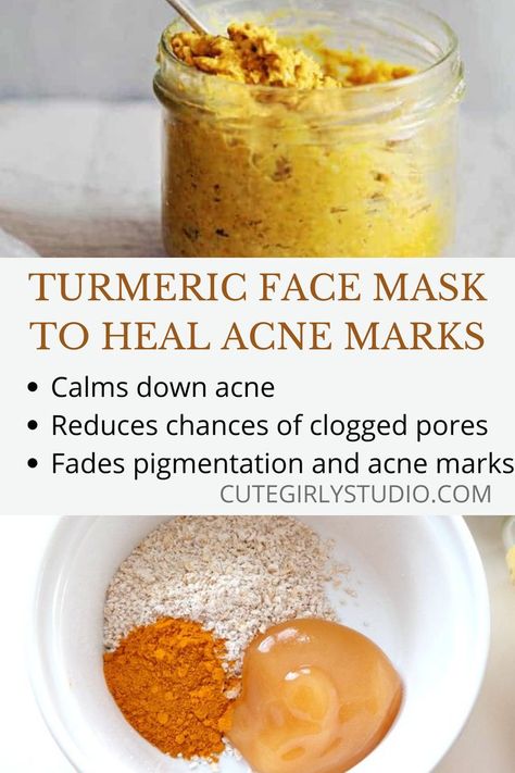 Using this DIY turmeric facemask helps to reduce acne breakouts to a great extent. It also reduces acne scars effectively. Diy Acne Mask, Acne Scar Diy, Acne Scar Remedies, Acne Scar Mask, Diy Turmeric Face Mask, Acne Scaring, Turmeric Mask, Pimples Under The Skin, Turmeric Face