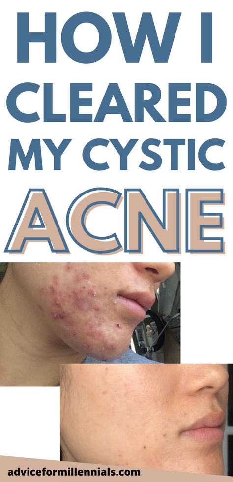 This is a detailed post about how I cleared my cystic acne without accutane. It was a long and painful journey, but I really want to share with you the products I used to heal my skin. Skincare | adult acne solutions | hormonal acne | adult acne Acne Prone Skin Care, Acne Help, Acne Overnight, Bad Acne, Acne Skincare Routine, Natural Acne Remedies, Acne Solutions, Hormonal Acne, Face Acne