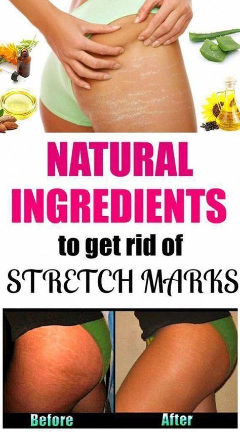 Natural Remedies, Skin Care Tips, Stretch Mark Remedies, Stretch Mark Cream, Stretch Mark, Baking Soda Shampoo, Nashville Tn, Easy Workouts, Skin Health