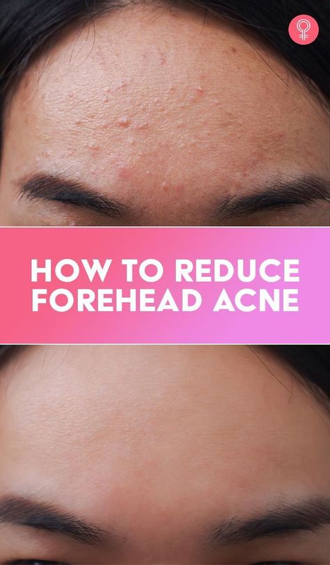 How To Reduce Forehead Acne Get Rid Of Forehead Acne, Nodule Acne, Forehead Bumps, Head Acne, Acne Beauty, Pimples On Forehead, Back Acne Remedies, Teenage Acne, Pimples Under The Skin