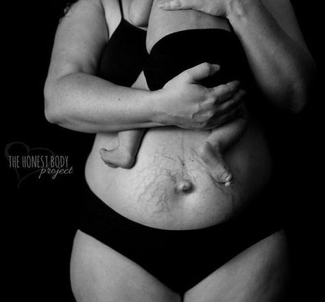 #Mothers celebrate their #postbaby bodies to spread an #inspirational msg http://bit.ly/1FWuz1v  @thehonestbodies Body Positivity Photography, Strech Marks, Body Positive Photography, Post Pregnancy Body, Mom Body, Belly Photos, Pregnancy Body, Postpartum Belly, Post Baby Body