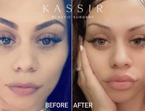 All about Lip Lift Surgery — Kassir Plastic Surgery in NY and NJ Lip Lift Surgery, Ethnic Rhinoplasty, Lip Lift, Chin Augmentation, Plump Lips, Lip Augmentation, Small Lips, Lip Filler, Brow Lift