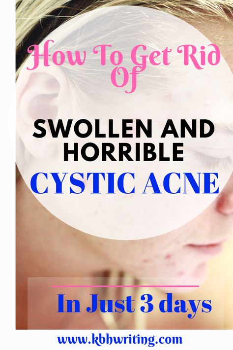 Get Rid Of Cystic Acne, Cystic Acne On Chin, Nodule Acne, Severe Acne Remedies, Treating Cystic Acne, Cystic Pimple, Cystic Acne Remedies, Forehead Acne, Acne Help