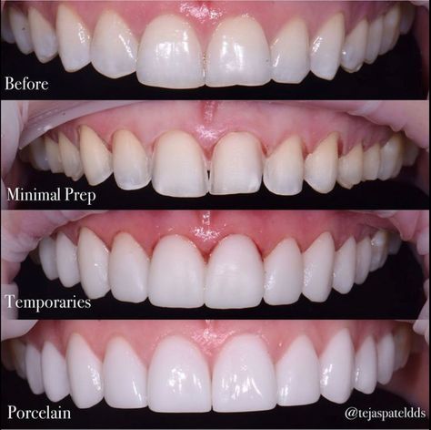 Round Teeth Shape, Vampire Veneers, Best Veneers Teeth, Veneers Black Women, Porcelain Veneers Before And After, Bad Veneers, Veneers Teeth Styles, Veneers Before And After, Celebrities With Veneers