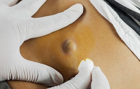 What It’s REALLY Like To Have A 10-Year-Old Cyst Removed Back Pimples, Lipoma Removal, Big Pimple, Cystic Pimple, Baby Acne, Zits Popping, Cystic Acne, Unwanted Hair Removal, Men’s Health