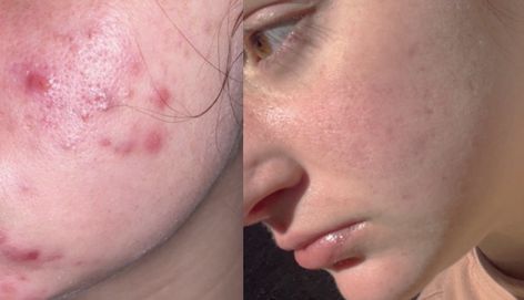 Acutane Before After, Accutane Month By Month, Accutane Before And After, Before And After Acne, Acne Medicine, Severe Acne, Last Resort, Healthy Juice Recipes, Face Acne