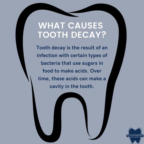 Tooth decay is damage to a tooth's surface, or enamel. It happens when bacteria in your mouth make acids that attack the enamel. Tooth decay can lead to cavities (dental caries), which are holes in your teeth. If tooth decay is not treated, it can cause pain, infection, and even tooth loss. Dental Awareness, Dental Post, Teeth Diagram, Severe Tooth Pain, Dental Assistant Study, Smile Tips, Dental Quotes, Dental Advertising, Dental Studio