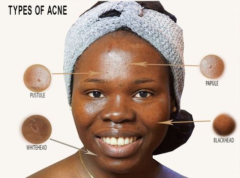 Face Acne Chart, Acne Placement Meaning, Types Of Pimples On Face, Pimple Types, Bacterial Acne, Papules Acne, Skin Routine Order, Acne Face Map, Acne Chart