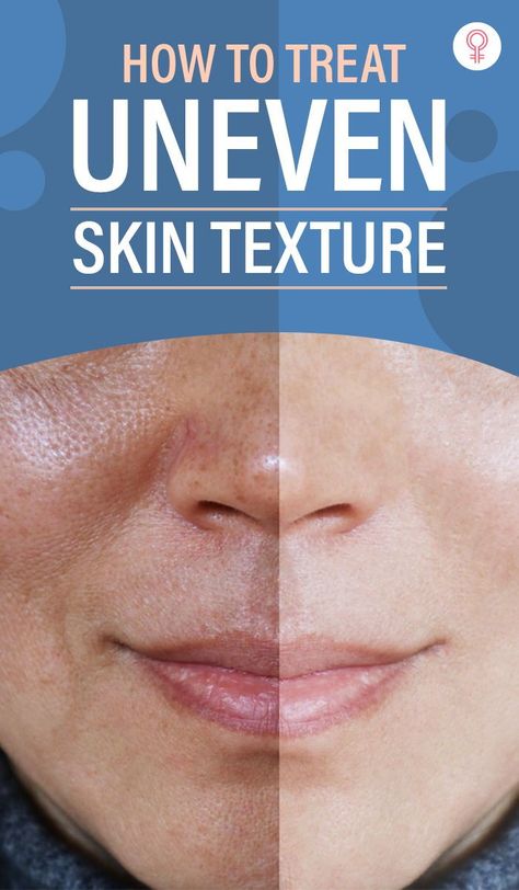 What To Use For Uneven Skin Tone, What Helps Textured Skin, How To Get Even Tone Skin, How To Treat Uneven Skin Tone, Improving Skin Texture, Blotchy Skin Remedies, Skin Issues On Face, How To Get Rid Of Uneven Skin Tone, How To Improve Skin Texture