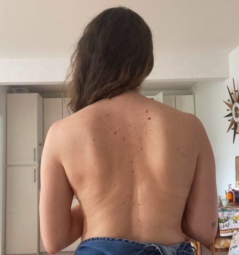 I Finally Conquered My Back Acne Scars At 32 — Here's How I Did It How To Treat Back Acne At Home, Back Acne Scar Removal, Acne Women, Natural Remedies For Acne, Acne Scar Remedies, Scar Remedies, Ruining My Life, Back Acne, Remedies For Acne