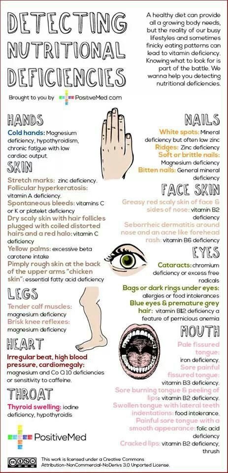 Detecting Vitamin/Nutrient defencies by symptoms Chart Nutrition Sportive, Hand Gestures, Nutritional Deficiencies, Health Info, Body Health, Health Remedies, Holistic Health, Healthy Tips, Healthy Body