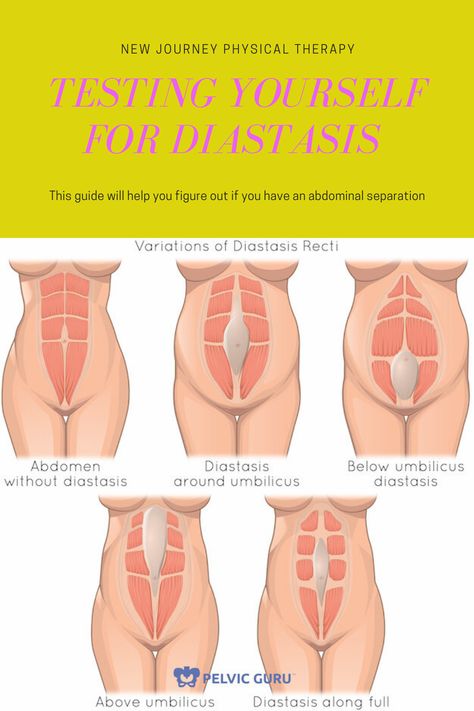 Diastasis Recti Looks Like, How Do You Know If You Have Diastasis Recti, Diastasis Recti Upper, Severe Diastasis Recti, Ab Separation Diastasis Recti Exercise, Diastis Recti Before And After, Diastasis Recti Taping, How To Get Rid Of Diastasis Recti, How To Check For Diastasis Recti