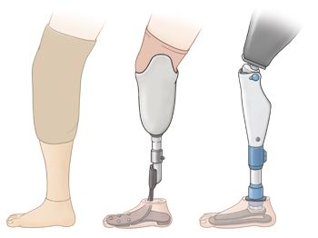 For the individuals who have prostheses for more everyday uses, however, their substitution limbs should be capable adjust to various situations and play out an assortment of functions, not simply excel in one discipline – Prosthetic leg meaning just like an actual leg. At Rinella Prosthetics, modern running edges have a particular snare shape, one of the most encouraging engineering approaches for regular prostheses is to closely model the biological design of a leg, lower leg, and foot. Prosthetic Leg Types, Leg Prosthesis Art, Prostethics Leg Drawing, Prostethics Leg, Prothestic Leg, Prosthetic Leg Drawing, Prosthetic Leg Design, Robotic Prosthetics, Leg Prosthesis