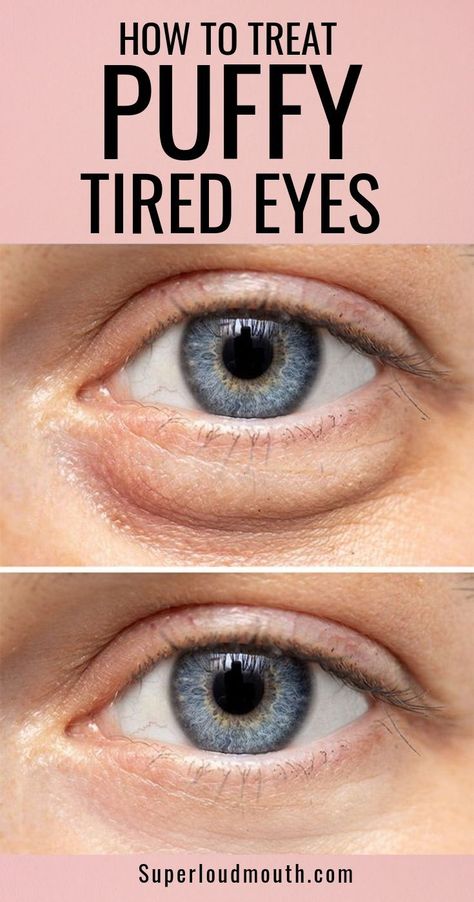 Eye Bag Remedies, Puffy Eyes Remedy, Baggy Eyes, Swollen Eyes, Under Eye Bags, Tired Eyes, Looks Black, Puffy Eyes, Eye Bags