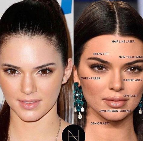 Kendall Jenner Plastic Surgery, Face Plastic Surgery, Cosmetic Fillers, Face Surgery, Face Fillers, Cheek Fillers, Facial Fillers, Celebrity Plastic Surgery, Cosmetic Dermatology