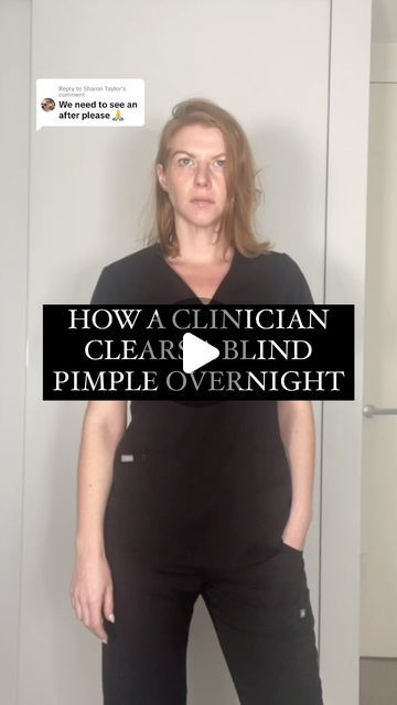 Jayde | Pimple patches will never work on blind pimples here’s why: 

I’ve been doing this technique for years by utilising the theory of acn... | Instagram Blind Pimple Remedies, Diy Pimple Patch, Deep Pimple, Inflamed Pimple, Blind Pimple, Pimple Patches, Pimples Remedies, Simple Science, Acne Causes
