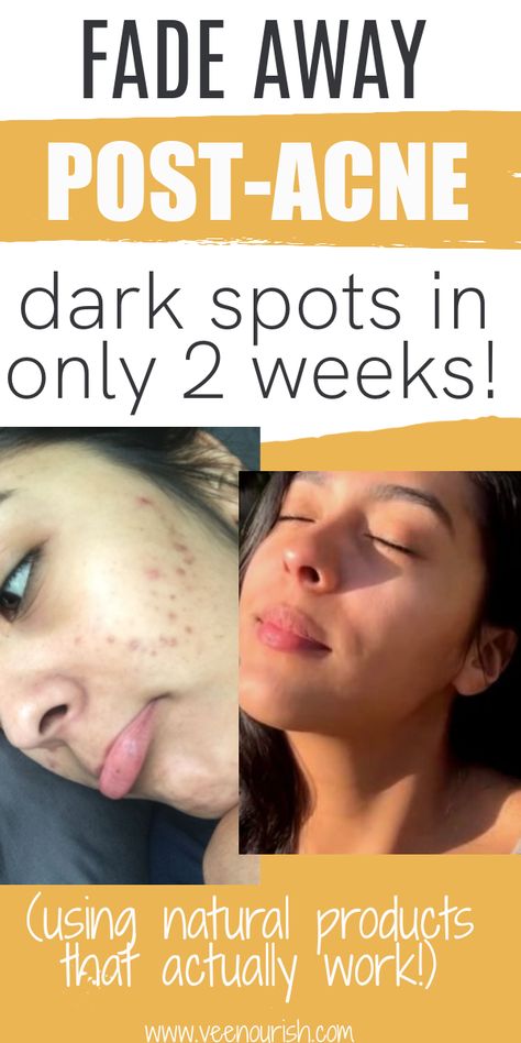 Post Acne Dark Spots Removal | How To Get Rid Of Acne Scars & Hyperpigmentation On Face Get Rid Of Black Spots On Face, How To Rid Of Dark Spots On Face, Face Pack For Acne Spots, How To Get Rid Of Dark Spots On Face Naturally, How To Remove Spots On Face, Dark Acne Spots Remedies, How To Lighten Dark Spots On Face, How To Get Rid Of Dark Acne Spots, How To Get Rid Of Acne Spots On Face