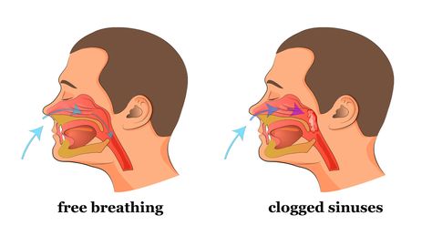 No one ever says that they like having a stuffy clogged up nose. When your sinuses are super blocked and you can only breathe out of your mouth it's more Nose Diagram, Clogged Nose, Stuffed Nose, Clogged Sinuses, One Week Diet Plan, One Week Diet, Sinus Remedies, Home Microdermabrasion, Blocked Nose