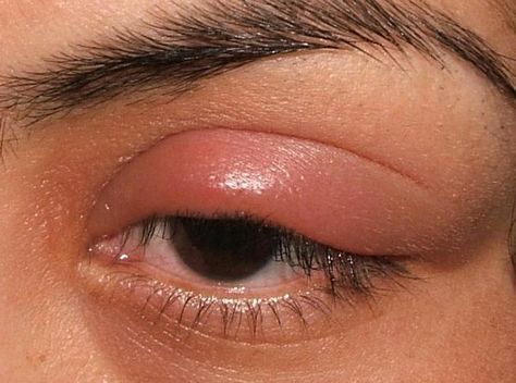 Stye is an eye inflammation in which the lower of upper eyelid swells due to the bacterial infection. It is mostly seen during winters and monsoons. Swollen Eyelids Remedy, Stye Remedy, Eye Stye Remedies, Swollen Eyelid, Acne Scar Remedies, Scar Remedies, Swollen Eyes, Toenail Fungus Remedies, Eye Infections
