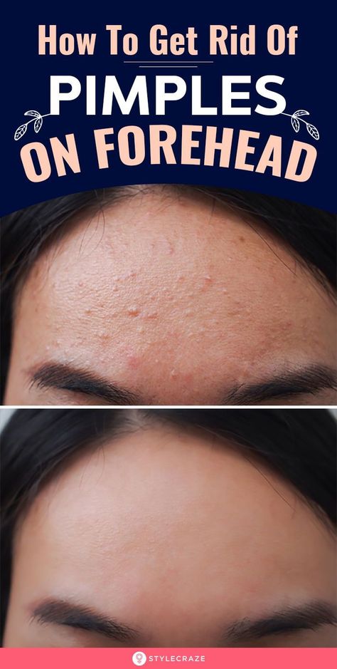 How To Get Rid Of Forehead Acne: This happens as a result of clogged pores as you are likely to be exposed to pollution, dust, and other impurities. We will discuss the causes of forehead acne… More Forehead Acne Cause, Get Rid Of Forehead Acne, Pimples On Forehead, Forehead Acne, Pimples Remedies, Skin Face Mask, Clear Skin Face, Natural Acne Remedies, Acne Causes