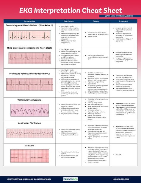 Use this EKG interpretation cheat sheet that summarizes all heart arrhythmias in an easy-to-understand fashion. Easy Ekg Interpretation Cheat Sheets, Ekg Rhythms Cheat Sheets, Heart Rhythm Nursing Cheat Sheets, Ekg Cheat Sheet, Telemetry Nursing Cheat Sheets, Ekg Interpretation Made Easy Cheat Sheets, Acls Cheat Sheet 2023, Acls Cheat Sheet 2019, Acls Rhythms Cheat Sheets