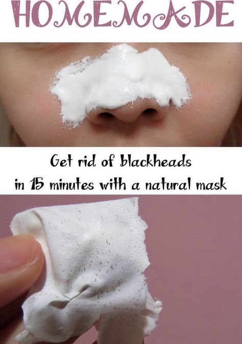 ✨Get Rid Of Blackheads In 15 Minutes With A Natural Mask!✨ Homemade Face Masks, Obličejové Masky, Make Up Diy, Homemade Face Mask Recipes, Natural Mask, Rid Of Blackheads, Face Mask Recipe, Get Rid Of Blackheads, Beauty Remedies