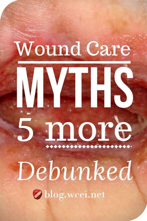 Wound Care Myths: 5 More Debunked - There are still plenty of wound care myths out there. Ready for the truth? You can handle it. via @woundcareeducat Heal Wounds Faster, Wound Care Nursing, Ostomy Care, Home Health Nurse, Leg Ulcers, Pressure Ulcer, Wound Dressing, Wound Care, Nursing Study