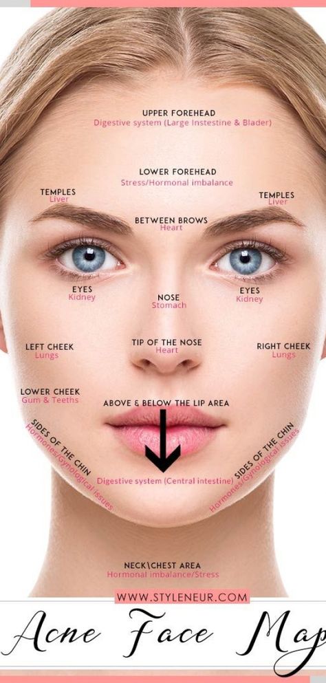 acne chart reasons ~ #acne #chart #reasons Forhead Acne, Acne Face Chart, Acne Chart, Acne Mapping, Acne Reasons, Blind Pimple, Face Mapping Acne, Forehead Acne, Marriage Story