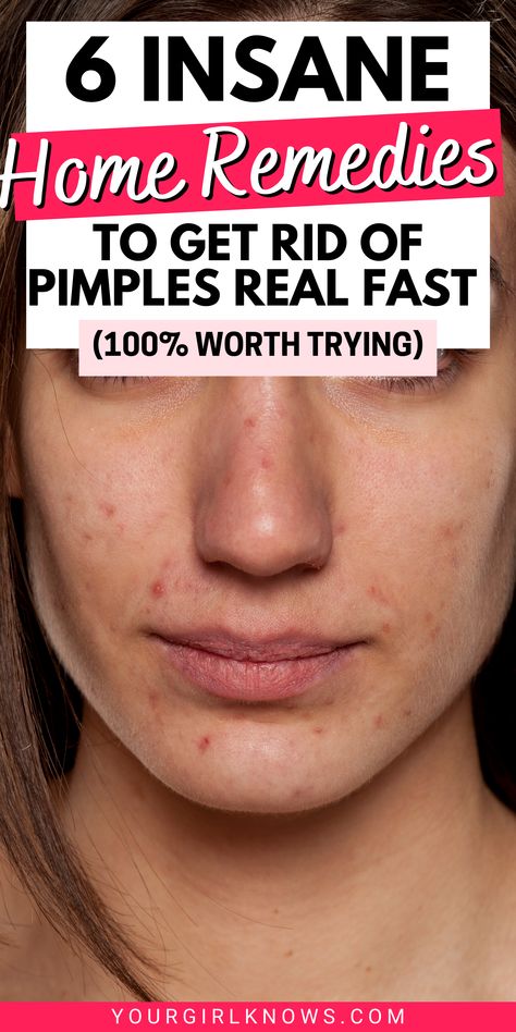 HOW TO GET RID OF ACNE AND PIMPLES AT HOME | YOURGIRLKNOWS #acne #pimples #pimplesremedies #acneremedies #skincarediy. https://whispers-in-the-wind.com/combatting-pimples-under-the-skin-expert-tips-and-product-recommendations/?241 Overnight Mask For Acne, How To Get Rid Of Pimples In 5 Minutes, Get Rid Of Zits Overnight, Rid Of Acne Overnight, Get Rid Of Acne Overnight, Acne Face Mask Homemade, Get Rid Of Acne Fast, Cheek Acne, Cystic Acne Remedies