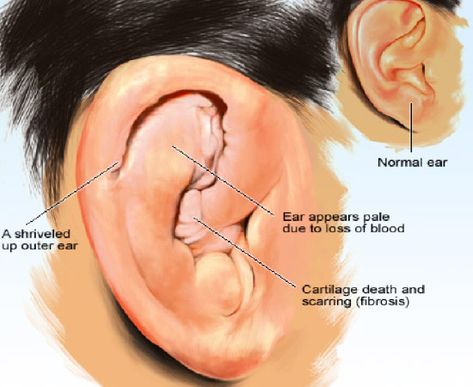 Around the mid-1800s, speculations arose regarding the condition of “cauliflower ear.”  Some thought it was a symptom of insanity, while others argued that it resulted from the insane hitting themselves, or being struck around the ear by psychiatric staff.… Jiu Jitsu, Muay Thai, Ufc, Martial Arts, Outer Ear, View Point, Things To Think About