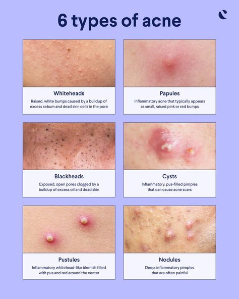 Acne Types, Nodule Acne, Different Types Of Acne, Mild Acne, Prevent Pimples, Pimples Under The Skin, Forehead Acne, Acne Overnight, Skin Advice