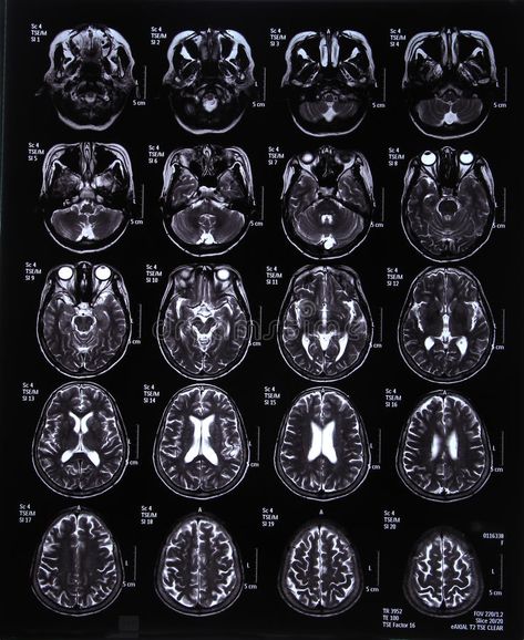 MRI scan image of brain stock photography Brain Medicine, Mri Brain, Brain Surgeon, Brain Images, Hospital Photography, Med School Motivation, Medical Wallpaper, Brain Anatomy, Mri Scan