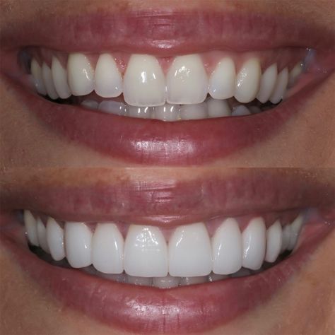 Teeth Makeover, Beautiful Smile Teeth, Grow Back Receding Gums, Whiten Teeth Fast, I Healed, Pretty Teeth, Veneers Teeth, Heal Cavities, Beautiful Teeth