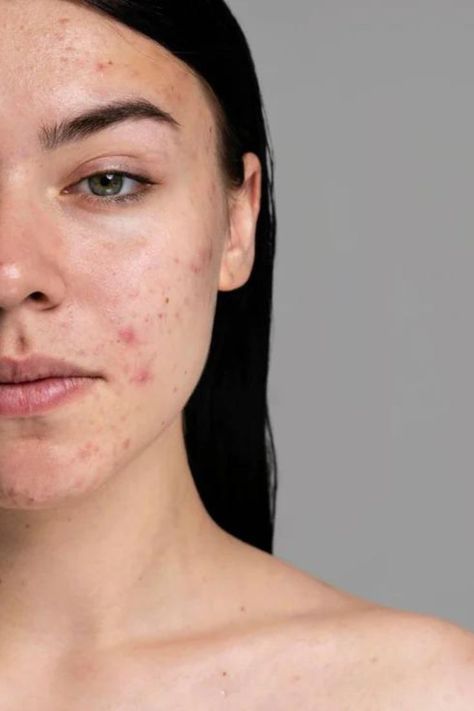 Clear your acne scars effectively with these simple steps Remove Skin Tags Naturally, Face Mapping Acne, Forehead Acne, Acne Overnight, Natural Acne Remedies, How To Get Rid Of Pimples, Health Signs, Acne Marks, Face Acne