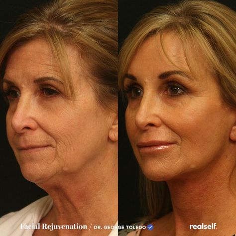 Loose Neck Skin, Neck Lift Surgery, Face Plastic Surgery, Mini Face Lift, Skin Tightening Procedures, Facial Procedure, Face Lift Surgery, Skin Tightening Treatments, Fat Grafting