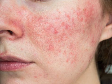 Everything You Need To Know About Rosacea | Chatelaine Acne Vulgaris, Acne Skincare Routine, Remove Acne, Skin Clinic, Skin Care Acne, Light Therapy, Skin Concern, Acne Prone, Dermatology