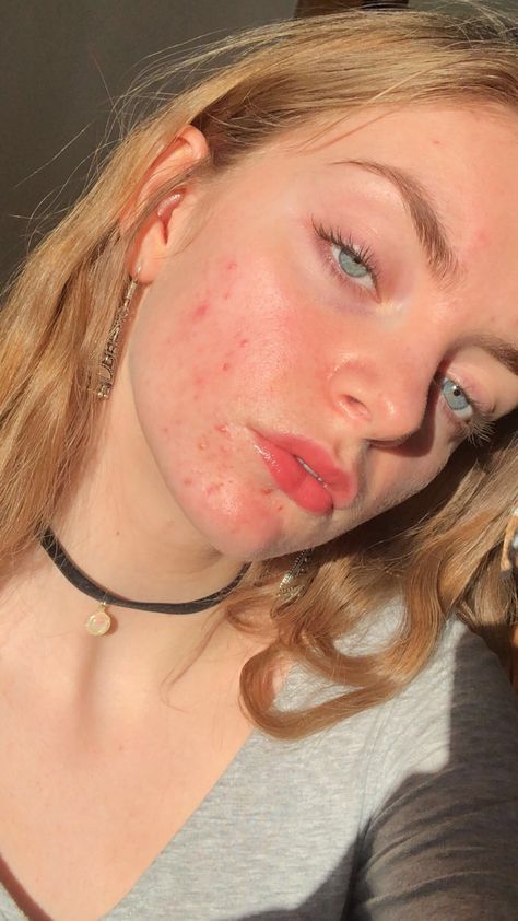 Girl With Acne Aesthetic, Acne Photos, Acne Pictures, Girl With Acne, Lemon Face Mask, Forehead Acne, Pimples On Face, Skin Aesthetics, Healing Remedies