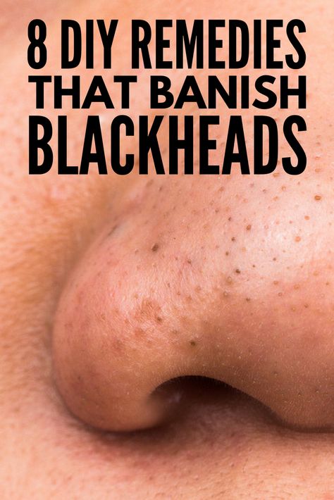 Hydrogen Peroxide Skin, Remove Blackheads From Nose, Blackhead Remover Diy, Clear Blackheads, Diy Makeup Brush, Blackhead Remedies, To Remove Blackheads, Blackheads On Nose, Rid Of Blackheads