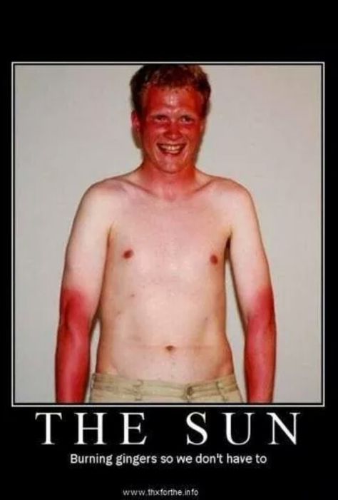 Ginger funnies Funny People, Sunscreen, Humour, Ginger Jokes, Farmers Tan, Bad Sunburn, Sun Tan, Tan Lines, Tanning