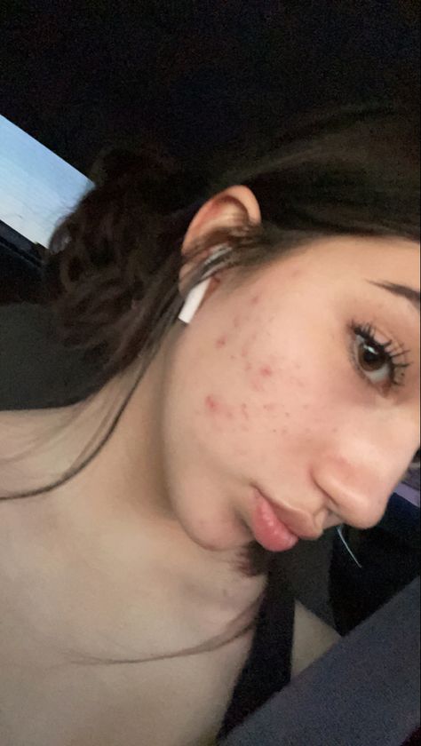 Acne Skin Aesthetic, Natural Acne Makeup, Beautiful Girls With Acne, Acne Normalization, School Makeup Acne, Back Acne Aesthetic, Beautiful People With Acne, Acne Aesthetic Girl, Natural Makeup Acne