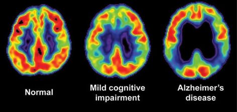 Signs Of Alzheimer's, Psychological Testing, Memory Test, Brain Images, Pet Scan, Healthy Holistic Living, Brain Scan, Mri Scan, Blood Test