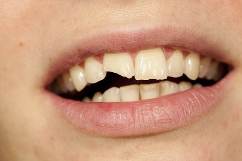 #Chippedteeth can be bothersome, both physically and aesthetically. Depending on the size and location of the chip, there are numerous repair solutions available. Tooth Extraction Aftercare, Tooth Extraction Healing, Pasta Gigi, Cracked Tooth, Chipped Tooth, Tooth Repair, Dental Implant Surgery, Kedokteran Gigi, Dental Implants Cost