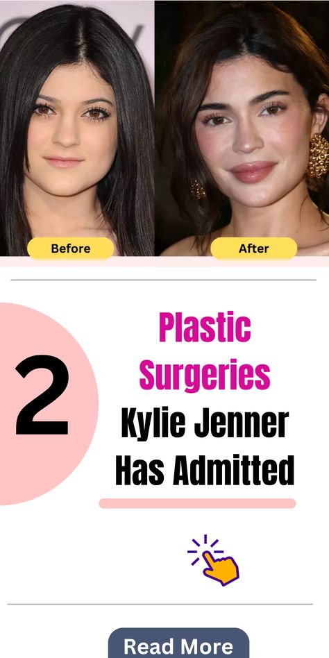 Kylie Jenner recently confessed to undergoing two plastic surgeries, clarifying that her face is mostly natural. Despite the rumors, she has denied any additional major alterations to her appearance. This revelation has sparked discussions about beauty standards and celebrity transparency. #KylieJenner #PlasticSurgery #BeautyStandards Kylie Jenner Before And After, Kylie Jenner Plastic Surgery, Tooth Pain Remedies, Face Plastic Surgery, Botched Plastic Surgery, Plastic Surgery Fail, Bad Plastic Surgeries, Plastic Surgery Photos, Kylie Jenner Lips