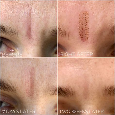 Fibroblast Plasma pen skin tightening and rejuvenation. Plasma pen treatment before and after // plasma fibroblast 
// plasma lift // plasma pen treatment // fibroblast skin tightening 
#fibroblast #plasmapen #skincare #plasmafibroblast #fibroblastskintightening #skintightening 
#microneedling #plasmalift #plasma #antiaging #fibroblastplasma #lipfiller #bbglow #skinrejuvenation 
#fibroblasting #skin #skinneedling #antiwrinkle #hifu #jawline #chemicalpeel #lifting Fibroblast Plasma, Plasma Fibroblast, Skin Tightening Procedures, Remove Skin Tags Naturally, Permanente Make-up, Marionette Lines, Plasma Pen, Skin Tightening Treatments, Clean Blackheads