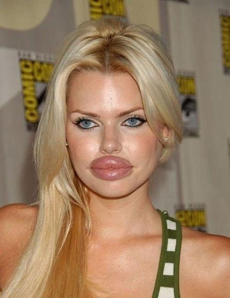 To be fair, I'm not sure if this woman is just having a really bad allergic reaction to something. If you did, miss, I hope you sought the medical attention needed. Lip Implants, Botched Plastic Surgery, Plastic Surgery Fail, Bad Plastic Surgeries, Plastic Surgery Gone Wrong, Celebrity Plastic Surgery, Reconstructive Surgery, Lip Injections, Cosmetic Procedures