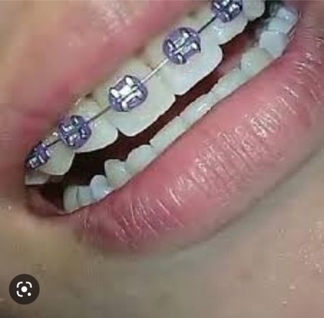 Braces Aesthetic Purple, Braces Colors Lavender, Braces Colors Purple, Braces Lavender, Mint Braces, Dark Purple Braces, Light Purple Braces, Lilac Braces, Lavender Braces