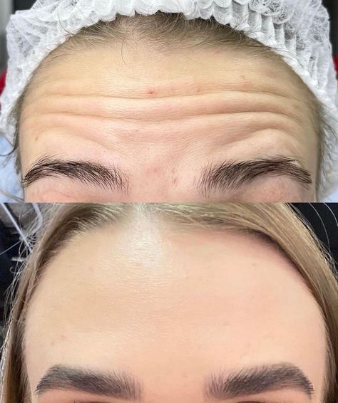 Botox Anatomy, Botox Video, Botox Aesthetic, Botox Results, Botox Facial, Botox Wrinkles, Botox Injection, Botox Before And After, Face Scars