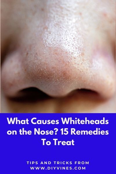 Whiteheads on nose are caused by oily skin, open skin pores and dirt. There are several whiteheads on nose removal remedies available. In this article I am sharing simple and easy home remedies to remove whiteheads on nose. #whiteheads #whiteheadsonnose #whiteheadsremovalremedies #howtoremovewhiteheads #beautytips #skincare How To Get Rid Of Whiteheads On Nose, Strawberry Nose Remedy, Oily Nose Remedy, Get Rid Of White Heads On Nose, How To Get Rid Of Strawberry Nose, Nose White Head Removal, How To Get Rid Of White Heads On Nose, How To Remove Whiteheads From Nose, White Heads Removal Remedies