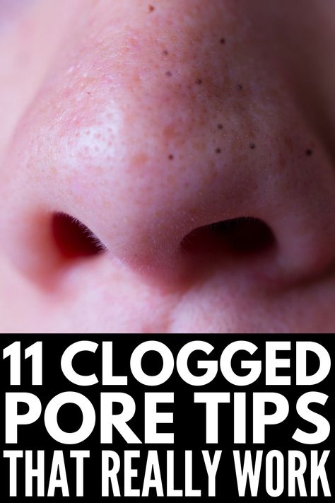 Clogged Pores On Nose, Get Rid Of Clogged Pores, Big Pores, Nose Pores, Blackheads On Nose, Face Pores, Clear Pores, Moisturizer For Oily Skin, Get Rid Of Blackheads