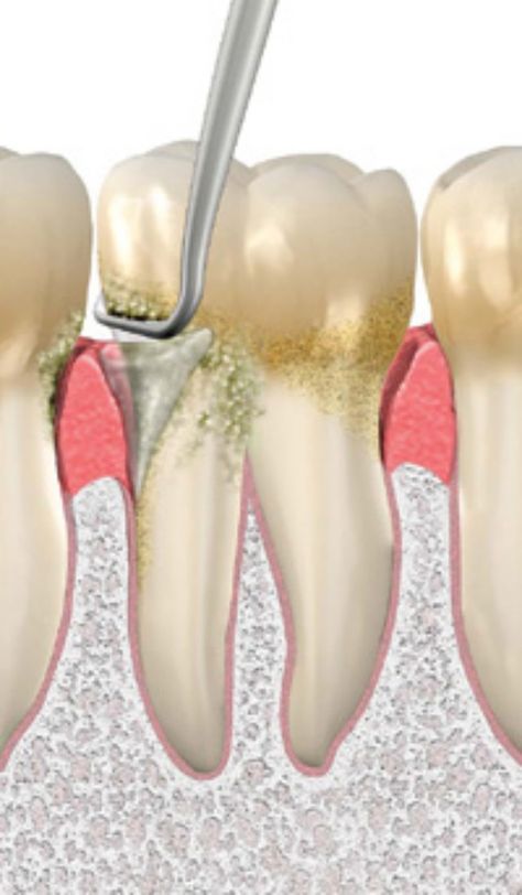 The hygienist uses dental instruments to  scale or remove bacterial plaque that has hardened and cannot be removed with brushing and flossing. If left on the tooth it will cause inflammation of the gums and will eventually lead to loss of bone that supports the teeth Dental Assisting, Dental World, Kesehatan Gigi, Dental Hygiene School, Dental Plaque, Dental Facts, Speak Spanish, Clean Teeth, Dental Art